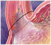 Gastro Esophageal Reflux And GI Lab