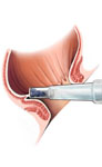 Colorectal surgery and hemorrhoid management