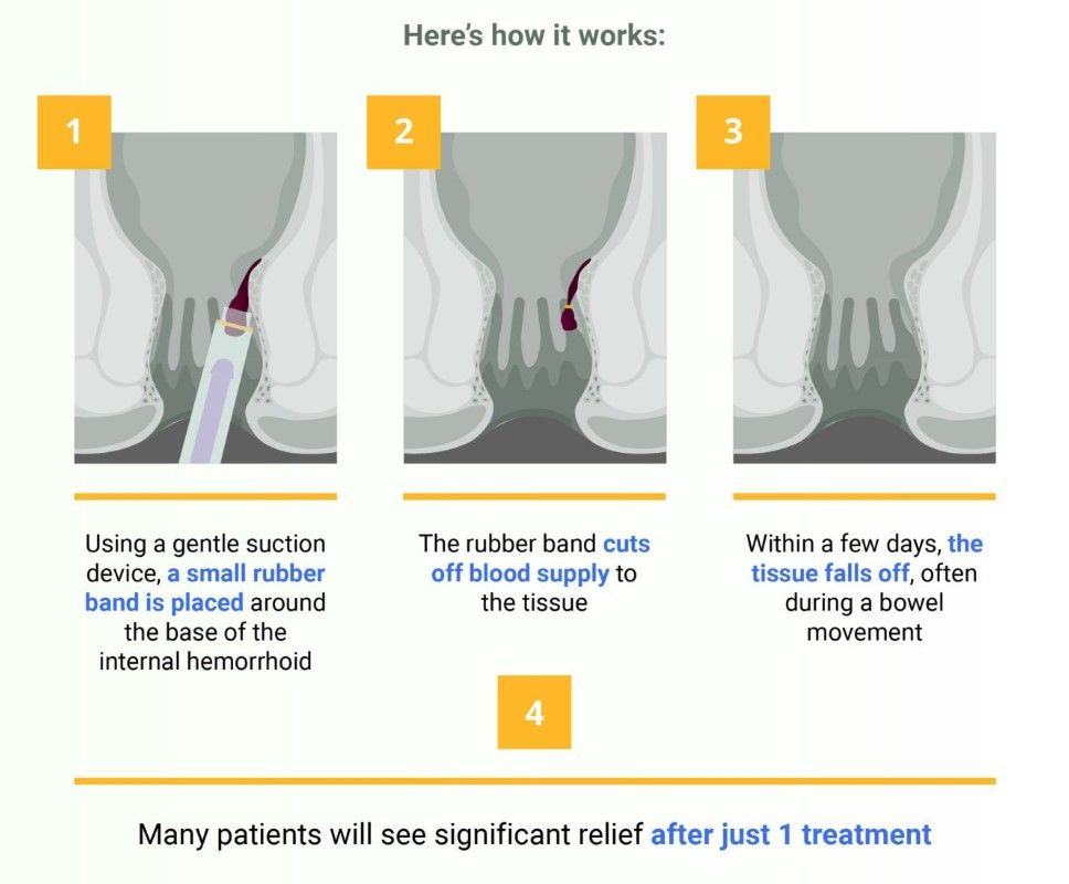 Oregon hemorrhoid banding procedure illustration