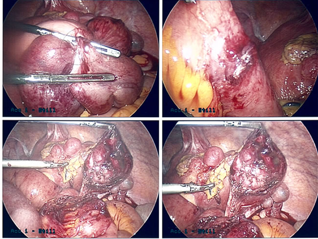 Intestinal Blockage From Adhesions