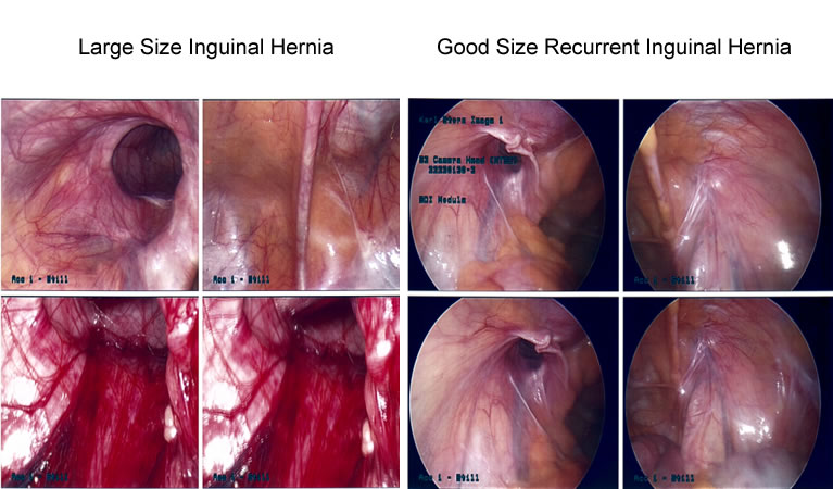 Ventral Hernia