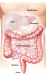 Laparoscopic Colon Resection