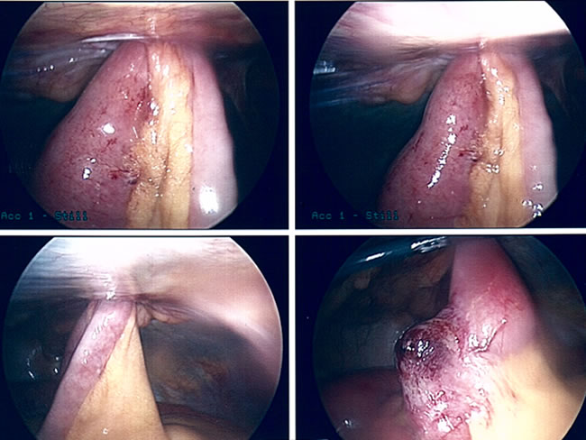 Obstructed Strangulated Ventral Hernia