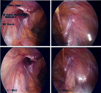 Ventral Hernia