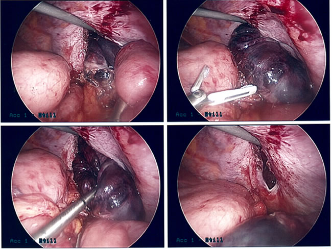 Diaphragmatic Hernia