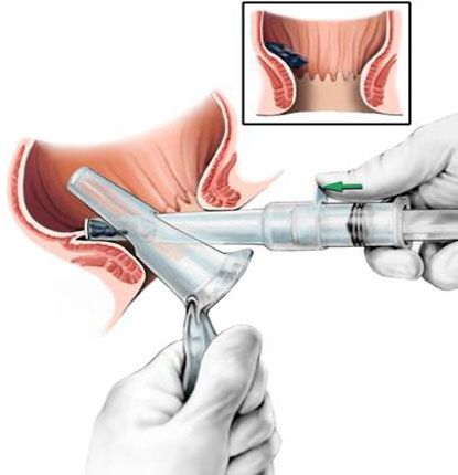 Hemorrhoid illustration