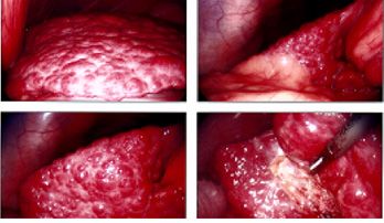 picture of Liver Cirrhosis