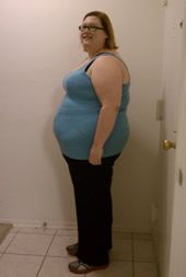 Before Bariatric Surgery