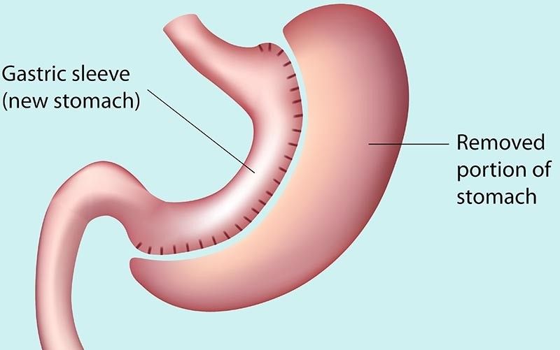 Illustration of gastric sleeve resection surgery
