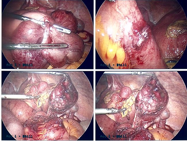 picture of Intestinal Blockage From Adhesions