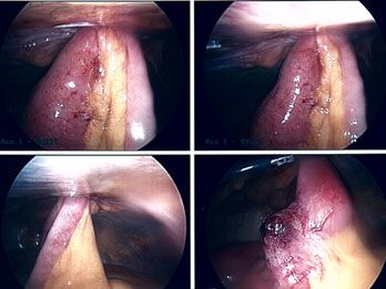 picture of Obstructed Strangulated Ventral Hernia
