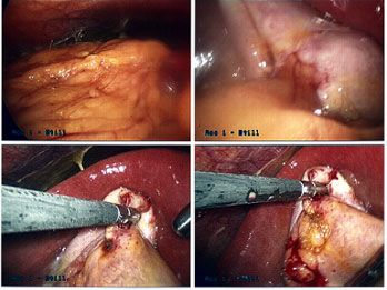 picture of Perforated Gall Bladder