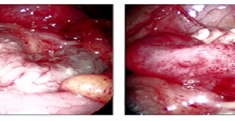 picture of Acute Appendicitis