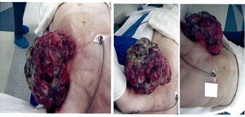 picture of Breast Cancer
