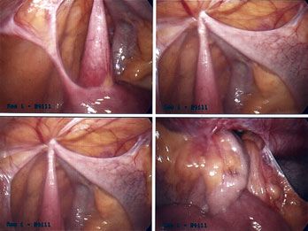 picture of Small Bowel Adhesions