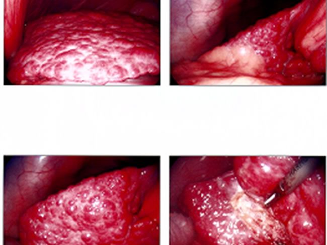 picture of Liver Cirrhosis