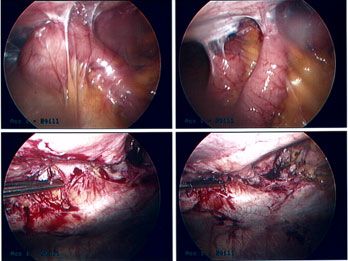 picture of Intestinal Adhesions