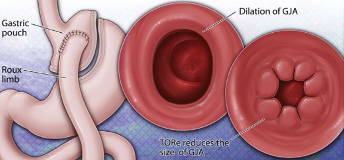 Illustration of TORe revision procedure for gastric bypass patients