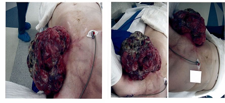 picture of Breast Cancer