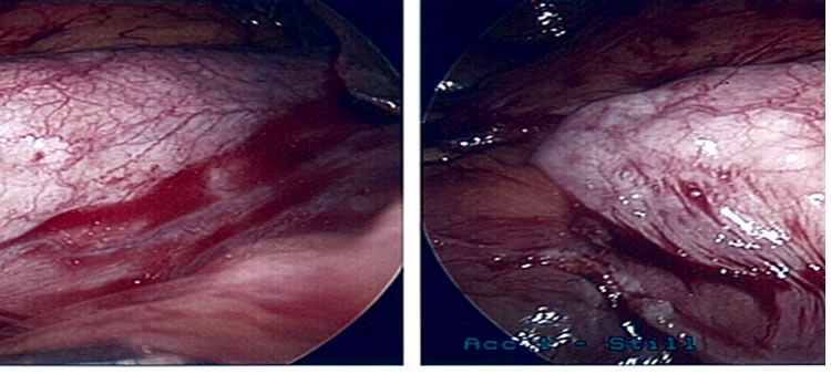 picture of Porcelain Gall Bladder