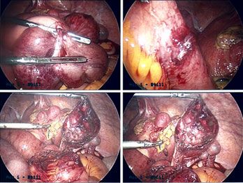 picture of Intestinal Blockage From Adhesions