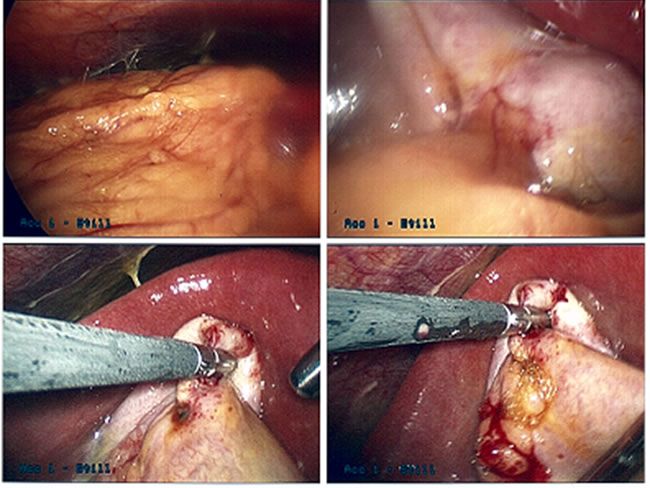 picture of Perforated Gall Bladder