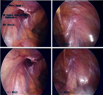 picture of Ventral Hernia