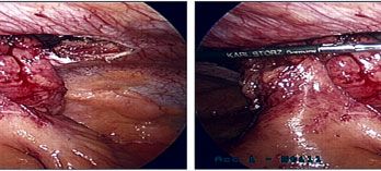 picture of Para Stomal Hernias
