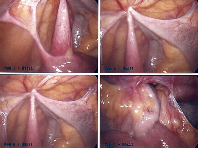 picture of Small Bowel Adhesions