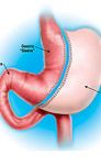 bariatric surgery
