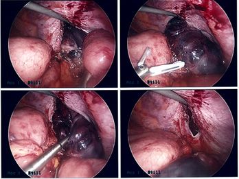 picture of Diaphragmatic Hernia