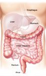 laparoscopic colon resection