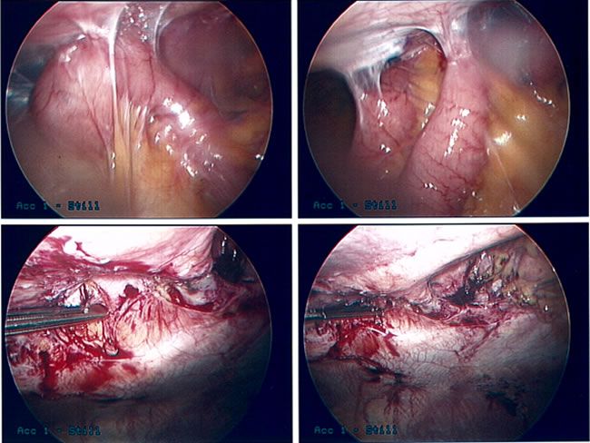 picture of Intestinal Adhesions