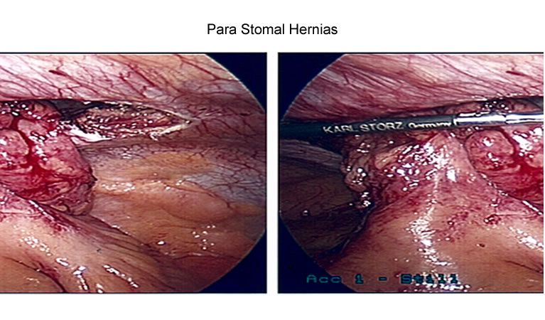 picture of Para Stomal Hernias