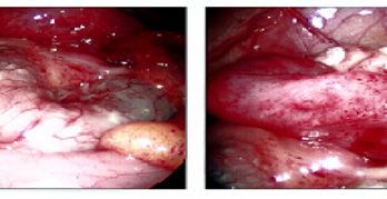 picture of Acute Appendicitis