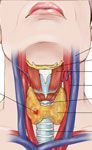 thyroid surgery