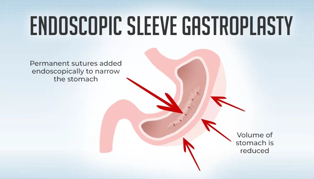 Illustration of endoscopic sleeve gastroplasty procedure