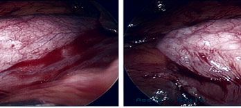 picture of Porcelain Gall Bladder