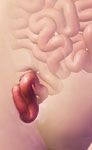 laparoscopic ventral hernia